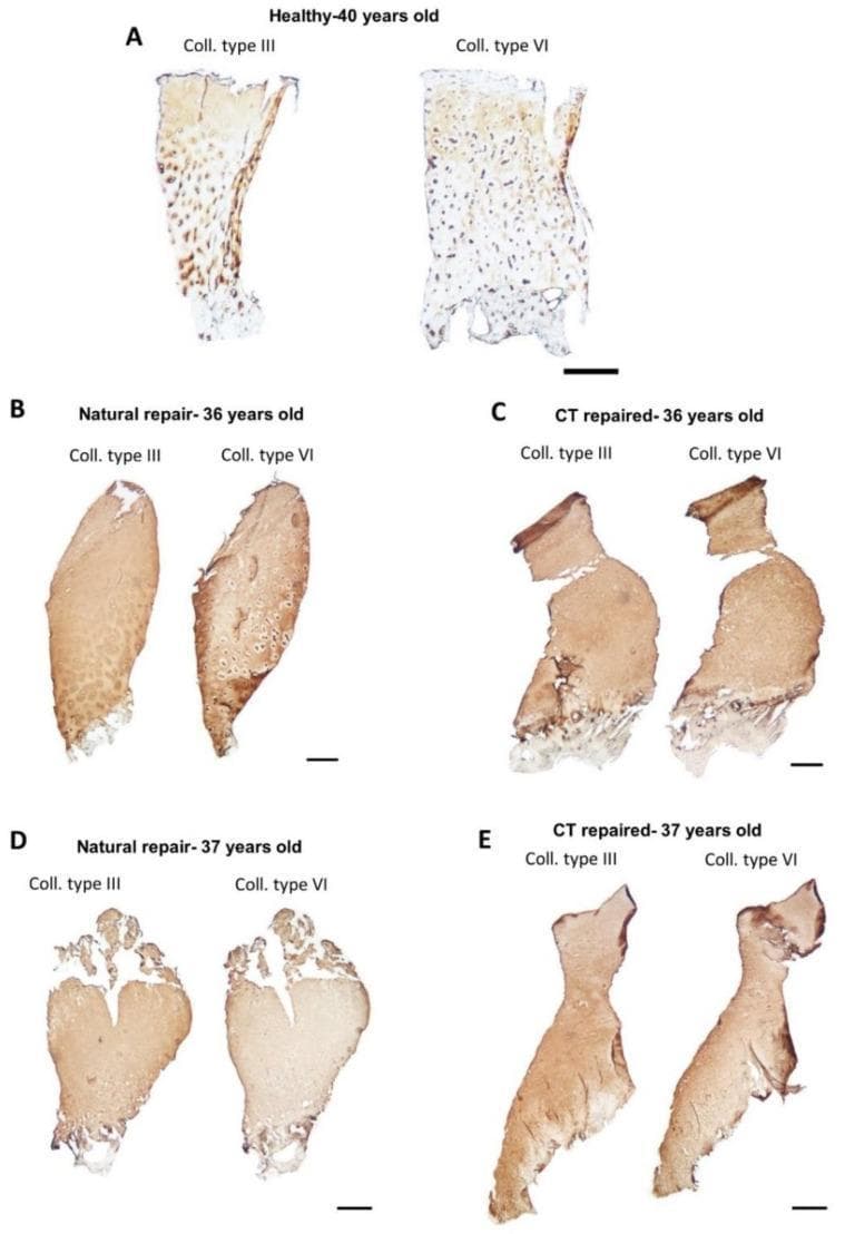 This diagnostic image set displays immunohistochemistry (IHC) staining of human articular cartilage core biopsies, comparing healthy tissue (A) with naturally repaired (B, D) and cell therapy (CT) repaired cartilage (C, E). The panels evaluate the spatial distribution of collagen type III and collagen type VI. In healthy cartilage (A), collagen type III is localized in the interterritorial matrix, whereas collagen type VI shows specific pericellular staining surrounding chondrocytes. In samples B and C (hyaline-like repair), these distinct localization patterns are partially preserved. In contrast, samples D and E (fibrocartilage repair) demonstrate a loss of specific regionalization, characterized by a more diffuse, homogenous staining pattern of both collagen types throughout the dense matrix. The images highlight differences in matrix organization and quality between hyaline and fibrocartilaginous repair tissues, serving as a markers for tissue regeneration success. Scale bars represent 500 µm.