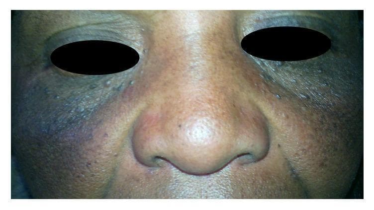 Clinical photograph of the mid-face of a patient with darker skin phototype demonstrating dermatological adverse effects of topical corticosteroid use. The image shows prominent, confluent, asymmetrical hyperpigmentation across the malar regions and cheeks, transitioning from deep brown to slaty bluish-black hues. In addition to the pigmentary changes, there are visible surface textural irregularities, including numerous small, skin-colored to slightly pigmented papules, suggestive of steroid-induced acne or follicular occlusion. Mild erythema is noted on the nasal bridge and alae. The clinical presentation illustrates exogenous pigmentary disorders and cutaneous atrophy often associated with the chronic or inappropriate application of high-potency topical steroids. This material is useful for medical education regarding iatrogenic skin conditions and the importance of monitoring topical therapy in dermatology.