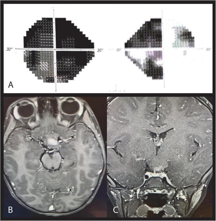 A multi-panel medical image illustrating neuro-ophthalmic pathology. Panel A displays Humphrey automated perimetry (visual field) results. The right eye (OD) shows a nasal hemianopia respecting the vertical meridian, while the left eye (OS) demonstrates near-complete field loss, indicating severe optic neuropathy. Panels B and C are T1-weighted post-contrast MRI scans in axial (B) and coronal (C) planes. They reveal a large, heterogeneously enhancing mass in the suprasellar, chiasmatic-hypothalamic region. The lesion is shown to involve the optic chiasm and extends posteriorly toward the left optic tract and anteriorly toward the left pre-chiasmatic optic nerve. The imaging and perimetry combination illustrates a left chiasmal syndrome, typically associated with optic pathway gliomas (common in patients with Neurofibromatosis type 1). This educational content demonstrates the correlation between structural brain lesions involving the visual pathway and their corresponding functional visual field defects.