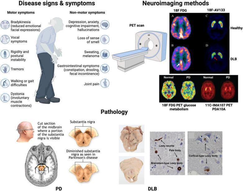 A comprehensive educational infographic summarizing the clinical features, neuroimaging, and pathology of Lewy Body (LB) diseases, specifically Parkinson's disease (PD) and Dementia with Lewy Bodies (DLB). The 'Disease signs & symptoms' section illustrates an elderly patient with classic PD posture, listing motor symptoms like bradykinesia, tremors, and rigidity, alongside non-motor symptoms such as cognitive impairment and hyposmia. The 'Neuroimaging methods' section compares PET scan modalities: 18F-FDG scans showing posterior cortical hypometabolism in DLB compared to healthy controls, and 18F-AV133 and 11C-IMA107 scans demonstrating dopaminergic and phosphodiesterase (PDA10A) alterations in PD and DLB. The 'Pathology' section features midbrain cross-sections highlighting the depigmentation of the substantia nigra characteristic of PD. It also includes histological images identifying hallmark protein aggregates: brainstem-type Lewy bodies, cortical-type Lewy bodies, Lewy neurites, and pale bodies. This diagram serves as a diagnostic and pathobiological overview of synucleinopathies for medical education.
