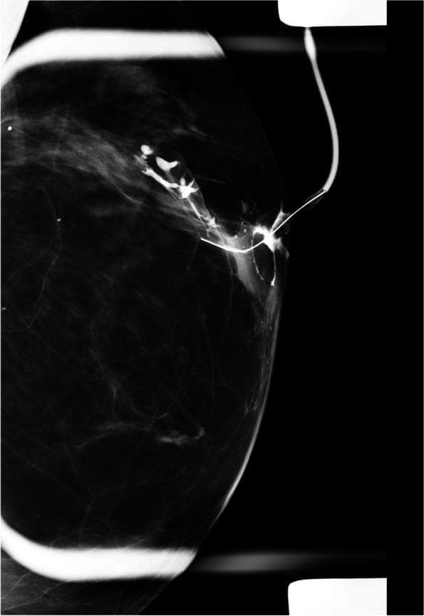 This diagnostic radiograph is a ductogram (galactogram) of the left breast, a specialized mammographic technique used to evaluate the ductal system. The image displays a retrograde injection of radiopaque contrast material through a cannula into a single lactiferous duct at the nipple. The primary findings include significant ductal dilatation (ectasia) of the main lactiferous duct. Distally, the contrast column terminates abruptly, demonstrating a clear ductal obstruction. Within the dilated segment, there is an irregular, intraluminal filling defect, suggesting the presence of an intraductal mass such as a papilloma or malignancy. The ductal wall appears irregular, and there is a noted displacement of adjacent ductal branches. This imaging modality is clinically indicated for the evaluation of pathologic nipple discharge when conventional mammography and ultrasound are inconclusive. The focal filling defect and distal obstruction are key diagnostic markers for identifying the location and character of potential intraductal lesions.