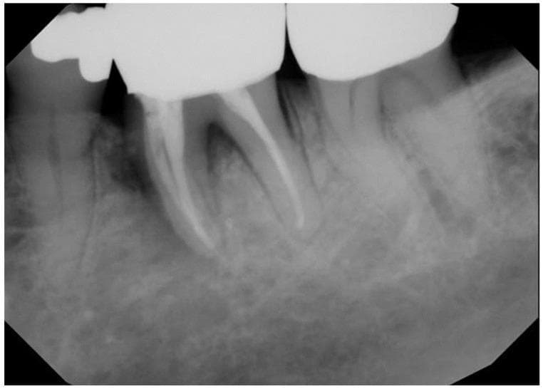 This diagnostic image is a periapical dental radiograph of the posterior mandible in a 69-year-old male with a history of high-dose radiation therapy (70 Gy) for squamous cell carcinoma. The radiograph reveals tooth #19 exhibiting a large, radiopaque dental crown and previous endodontic treatment, evidenced by radiopaque filling material in the root canal system. The surrounding alveolar bone shows generalized radiolucency and a granular, diffuse trabecular pattern, which are radiographic hallmarks of post-radiation bone changes. These findings indicate compromised bone density and vascularity, increasing the risk for osteoradionecrosis (ORN) following invasive procedures. There is evidence of a periapical radiolucency associated with the molar, consistent with the clinical report of a draining abscess. The image serves as an educational example of evaluating dental health and bone integrity in head and neck cancer patients prior to dentoalveolar surgery.