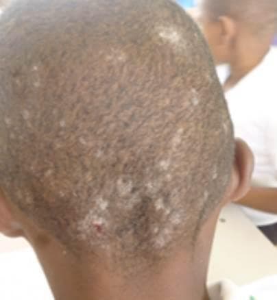 This clinical photograph displays a posterior view of a child's scalp exhibiting multiple discrete, circular patches of alopecia characteristic of Tinea capitis. The affected areas show visible scaling and a lighter, hypopigmented appearance compared to the adjacent healthy scalp. Within several of the alopecic patches, small dark specks are visible, suggesting 'black dot' alopecia caused by hairs breaking off at the skin surface. A focal area of erythema or a small excoriation is noted near the occipital hairline, potentially indicating irritation or secondary infection. The distribution is multifocal and concentrated across the vertex and occipital regions. These findings are consistent with an anthropophilic fungal infection, such as Trichophyton tonsurans, typically seen in pediatric populations and characterized by endothrix hair shaft invasion.