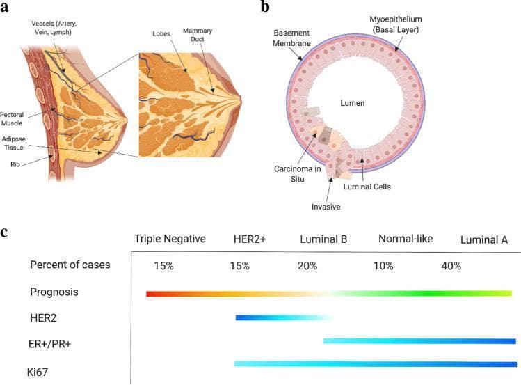 This composite educational infographic illustrates the anatomy of the human breast, its cellular structure, and the molecular subtyping of breast cancer. Panel (a) presents an anatomical diagram of the whole breast in cross-section, labeling the pectoral muscle, ribs, adipose tissue, and the functional unit consisting of lobes and mammary ducts. Panel (b) depicts the cellular anatomy of a mammary duct in cross-section, showing the basement membrane, myoepithelium (basal layer), and luminal cells surrounding a central lumen. It highlights pathological progression from carcinoma in situ to invasive carcinoma, demonstrating the breach of basement membrane integrity. Panel (c) is a comparison chart of breast cancer molecular subtypes: Triple Negative, HER2+, Luminal B, Normal-like, and Luminal A. It correlates these subtypes with clinical and pathological features, including percentage of cases, prognosis (gradient from poor/red to good/green), and the expression levels of key biomarkers such as HER2, ER+/PR+, and Ki67. The visual is designed for medical education regarding oncology subtyping and pathophysiology.