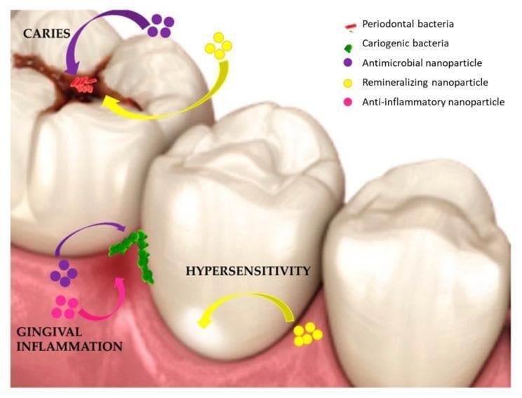 This medical infographic illustrates the therapeutic applications of nanotechnology in oral health, specifically focusing on the delivery of functional nanoparticles (NPs) to treat common dental conditions. The anatomical diagram shows several teeth affected by caries, gingival inflammation, and hypersensitivity. A legend identifies five key components: periodontal bacteria (red rod-shaped clusters), cariogenic bacteria (green chain-like structures), antimicrobial NPs (purple circles), remineralizing NPs (yellow circles), and anti-inflammatory NPs (pink circles). Curved arrows depict the targeted delivery pathways: 1) Antimicrobial and remineralizing NPs are directed toward an occlusal caries lesion on a molar. 2) Anti-inflammatory and antimicrobial NPs target gingival inflammation at the interproximal gumline, where cariogenic bacteria are localized. 3) Remineralizing NPs are directed toward the cervical region of a premolar to address dentin hypersensitivity. This educational visualization demonstrates how specialized nanomaterials can be used in restorative and periodontal treatments to counteract bacterial pathogens and promote tissue healing and remineralization.