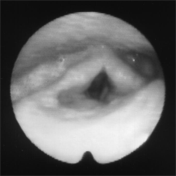 This clinical diagnostic image shows an endoscopic view of the larynx, specifically a fiberoptic laryngoscopy capturing the glottis at rest following botulinum toxin (Botox) injection. Centrally, the true vocal folds are visible, appearing relatively relaxed and positioned in a neutral or slightly adducted state. The glottic opening (rima glottidis) is seen as a dark, roughly diamond-shaped space between the vocal folds. Posteriorly, the arytenoid eminences and the interarytenoid area are discernible as soft tissue contours. The image demonstrates the pharmacological effect of Botox on the laryngeal musculature, likely the thyroarytenoid or lateral cricoarytenoid muscles, used to treat conditions such as adductor spasmodic dysphonia or paradoxical vocal fold motion. The mucosa appears healthy without evidence of gross lesions, masses, or acute inflammatory exudate. This visual serves as an educational reference for the post-procedural appearance of the laryngeal framework during medical management of laryngeal dystonia.