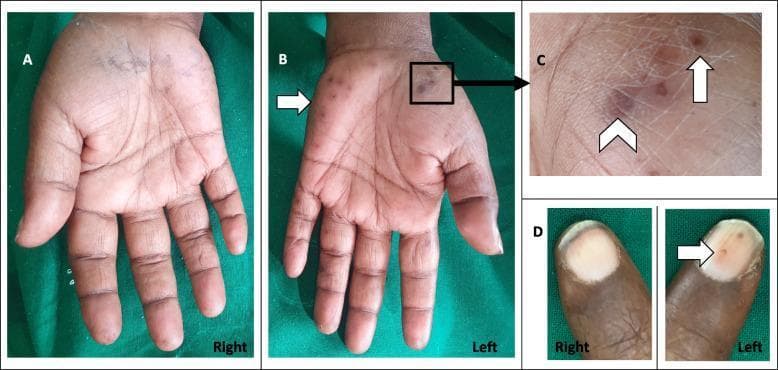 This composite clinical photograph displays the physical findings of infective endocarditis manifest in the hands. Panel A shows a normal right palm for comparison. Panel B illustrates the left palm with multiple erythematous to violaceous lesions located on the thenar and hypothenar eminences. Panel C provides a magnified view of these palm lesions, distinguishing between Osler's nodes—small, raised, tender, reddish-purple nodules (marked with an arrow)—and Janeway lesions, which are flat, non-tender, erythematous macules (marked with an arrowhead). Panel D compares the nailbeds, highlighting a splinter hemorrhage on the left digit, characterized by a small, linear, dark-red streak beneath the nail plate, while the right nailbed appears normal. These peripheral stigmata are classic clinical indicators of septic emboli or immunological responses associated with systemic infections like endocarditis or infected arteriovenous fistulas.