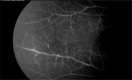 This diagnostic image is a Fundus Fluorescein Angiography (FFA) of the right eye, illustrating typical vascular findings associated with ocular inflammatory conditions such as periphlebitis. The image demonstrates widespread, diffuse hyperfluorescence across the posterior pole and mid-periphery. Key features include segmental perivenous hyperfluorescence, characterized by minimal vascular leakage and staining of the retinal vessel walls, particularly evident along the major vascular arcs. The vascular morphology shows increased permeability without frank neovascularization. This imaging is clinically significant for detecting active or chronic retinal vasculitis and perivenous sheathing, common in systemic conditions like Multiple Sclerosis. The background reveals a mottled fluorescence pattern, likely corresponding to mild vitreous haze or secondary retinal pigment epithelium changes. This visual is intended for intermediate to advanced medical learners focusing on ophthalmology and neuro-ophthalmology to understand the angiographic presentation of retinal inflammatory disease.