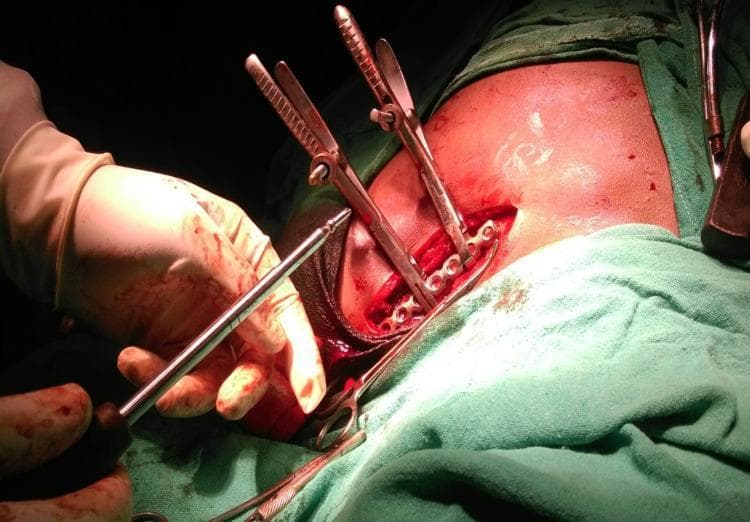 An intraoperative clinical photograph demonstrating an Open Reduction Internal Fixation (ORIF) of a midshaft clavicle fracture. The image shows a sterile surgical field with an incision exposing the clavicle's anterosuperior surface. A contoured anatomical locking compression plate is positioned across the fracture site. Two pointed reduction clamps are applied to maintain cortical alignment and bone-to-plate contact. A gloved hand is visible using a screwdriver or drill bit to secure fixation screws through the plate's circular and elongated dynamic compression holes. The surgical area is bounded by green sterile drapes and shows minor physiological hemorrhage typical of orthopedic procedures. This visual illustrates the surgical technique for managing displaced clavicular fractures, highlighting the relationship between the anatomical plate, temporary reduction clamps, and permanent screw fixation for interfragmentary compression and stability.