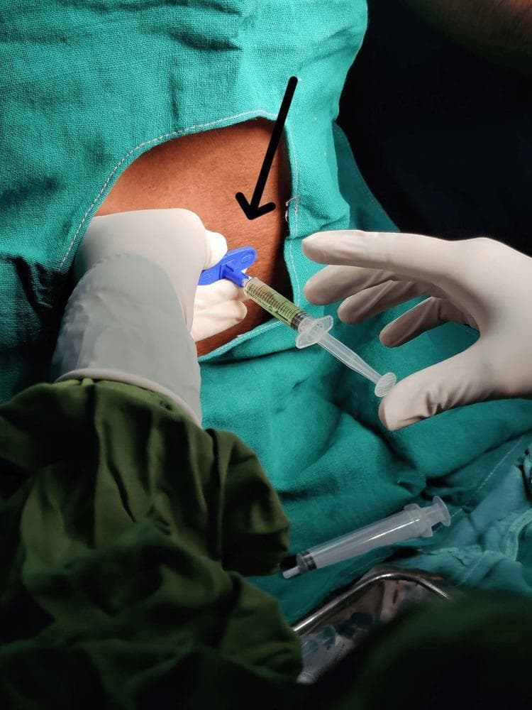 Clinical photograph demonstrating an epidural platelet-rich plasma (PRP) infiltration procedure in a patient with lumbar disc herniation. The image shows a sterile surgical field created by green fabric drapes. A clinician, wearing white sterile gloves, is performing the injection. A syringe containing a straw-colored, yellow fluid (PRP) is connected via a blue winged hub/connector to a needle already inserted into the skin of the lumbar region, as indicated by a black directional arrow. A second gloved hand is visible stabilizing the needle hub. In the foreground, an additional unused syringe rests on a metal instrument tray within the sterile field. The procedure illustrates a minimally invasive biological therapy for chronic low back pain and radiculopathy, serving as a teaching tool for interventional pain management and musculoskeletal regenerative medicine.