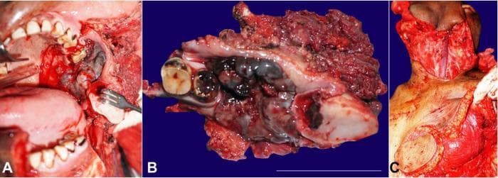 This composite of three clinical photographs documents the surgical management of oral malignant melanoma. Panel A provides an intraoperative view of a wide local excision involving a left segmental mandibulectomy and infrastructural maxillectomy. A large, irregular, darkly pigmented (melanotic) mass is visible in the retromolar trigone region, surrounded by surgically exposed anatomical landmarks including the tongue and remaining maxillary teeth. Panel B shows the gross surgical specimen, highlighting a 5.6 cm pigmented, lobulated tumor mass involving the alveolar process with two molar teeth attached to the resected bone. The specimen exhibits characteristic black-to-dark-blue pigmentation indicative of melanoma. Panel C demonstrates the reconstructive phase, specifically the harvesting of a left-sided pectoralis major myocutaneous (PMMC) flap. This panel shows the donor site on the chest with the vascularized muscle and skin paddle prepared for transposition to the oral cavity defect. These images illustrate the oncological resection and subsequent reconstructive strategy required for aggressive head and neck mucosal malignancies.