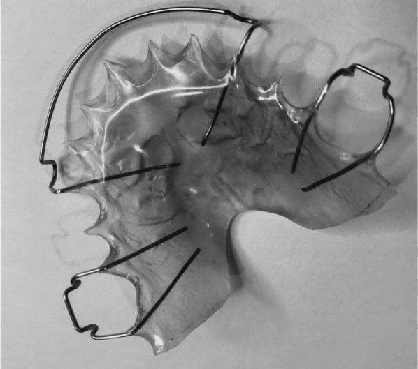 This clinical photograph displays a maxillary Hawley retainer, a classic removable orthodontic appliance used for post-treatment stability and retention. The device features a contoured, transparent acrylic base plate designed to fit the patient's palatal vault and dental arch. Embedded within the acrylic are several stainless steel wire components. A prominent labial bow spans the anterior section, intended to maintain the alignment of the incisors. On either side, Adams clasps or similar retentive wire loops are visible, which engage the molar or premolar regions to secure the appliance in place. The scalloped edges of the acrylic base are precisely molded to follow the lingual gingival margins of the maxillary teeth. This image serves as an educational example of orthodontic retention materials used to maintain trans-arch stability following transverse expansion or comprehensive orthodontic treatment.