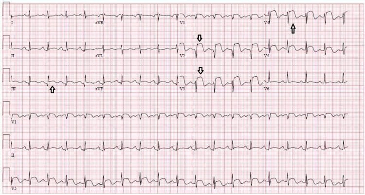 This diagnostic image is a 12-lead electrocardiogram (ECG) demonstrating signs of an acute ST-elevation myocardial infarction (STEMI). The tracing reveals significant ST-segment elevation in the anterior leads (V1-V4) and inferior leads (II, III, and aVF), with black arrows highlighting specific areas of elevation. In lead V2 and V3, the ST-segment shows an upward-sloping, concave morphology, while lead V4 displays a more pronounced, 'tombstone' appearance merging into hyperacute T-waves. Reciprocal ST-segment depression is visible in the lateral leads, specifically I and aVL. The rhythm is sinus, and the heart rate is approximately 75-80 beats per minute. The ECG is clinically significant for multi-territory ischemia, correlating with proximal left anterior descending (LAD) artery occlusion and multi-vessel coronary artery disease. This visual is an essential educational resource for medical students and clinicians for identifying acute coronary syndromes and understanding the distribution of myocardial injury across various cardiac walls.