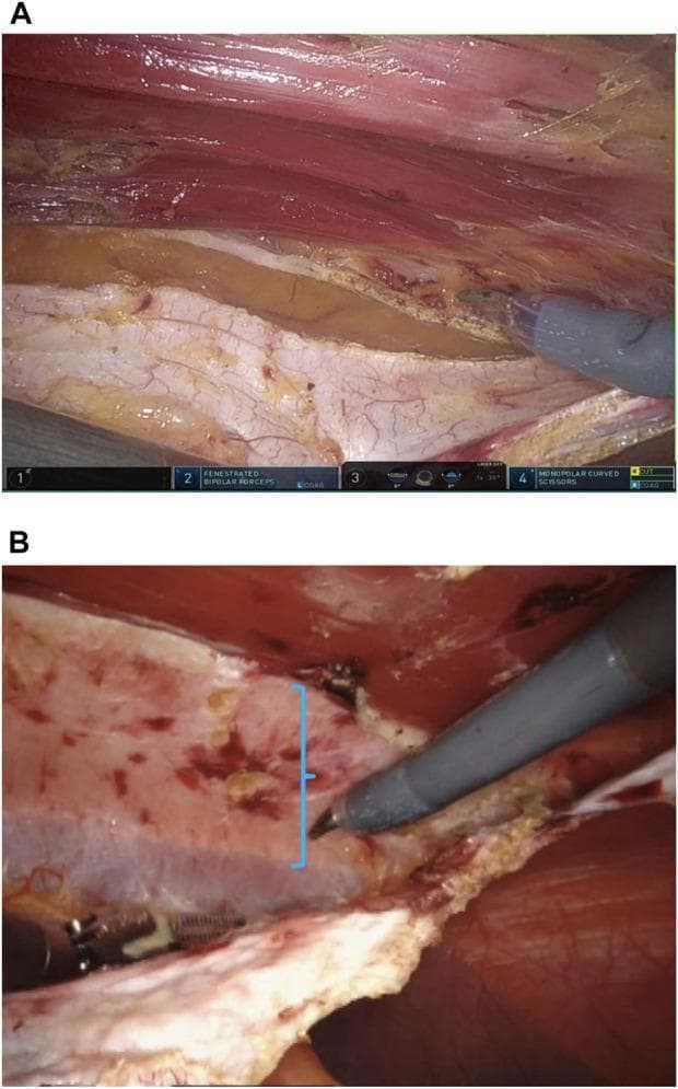 Two-panel intraoperative clinical photograph (A, B) captured during a robotic-assisted abdominal wall hernia repair. Image A demonstrates the crossover maneuver, where the posterior rectus fascia is being incised approximately 0.5–1 cm medial to its junction with the anterior rectus sheath. Visible tissues include the reddish, striated fibers of the rectus muscle and the pale, fibrous posterior rectus sheath. Robotic instrumentation (monopolar curved scissors) is shown performing the dissection to enter the preperitoneal space. Image B highlights a rectus diastasis, indicated by a blue bracket, with visible stretching of the midline fibrous tissue. Shadowing fibers of the contralateral rectus muscle are coming into view as the dissection progresses. The visual demonstrates key surgical steps in retromuscular dissection, including the preservation of the linea alba ventrally and the peritoneum dorsally. The content is intended for surgical education, specifically illustrating the anatomy and technical steps for robotic eTEP (enhanced-view Totally Extraperitoneal) hernia repair and diastasis recti management.