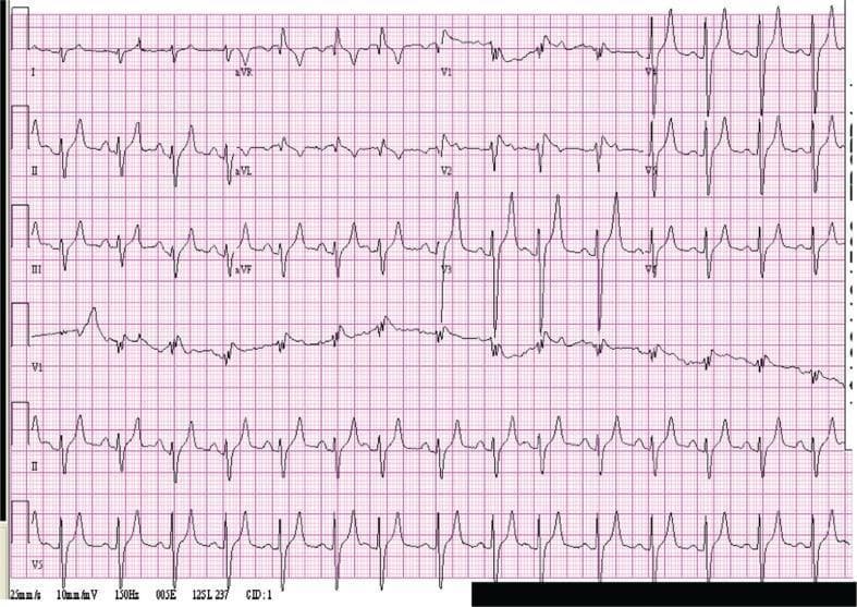 This diagnostic image is a 12-lead electrocardiogram (ECG) demonstrating classic features of severe hyperkalemia in a patient with a serum potassium level of 8.0 mEq/L. The tracing shows prominent, tall, and peaked T-waves, most notable in the precordial leads V2 through V5 and inferior leads II, III, and aVF. These T-waves exhibit a characteristic 'tent-like' morphology with a narrow base and sharp peaks. Additionally, the ECG reveals widening of the QRS complexes, which is particularly evident in leads V1 to V3, indicating delayed intraventricular conduction. There is also an apparent flattening or absence of P-waves, a common finding as hyperkalemia progresses toward a sinoventricular rhythm. This visual represents a critical electrolyte emergency requiring immediate clinical intervention to prevent cardiac arrest. It serves as a classic educational example for medical students and clinicians to recognize the progression of hyperkalemic cardiotoxicity.