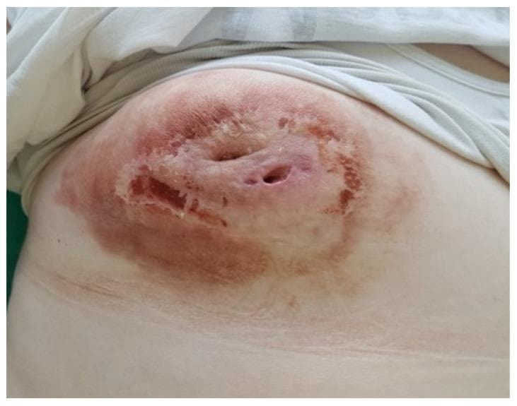 This clinical photograph shows the right breast of a patient following the treatment and evacuation of a purulent inflammatory lesion, such as a severe breast abscess or mastitis. The image demonstrates significant dermatological and structural changes: the central area exhibits persistent nipple retraction and several visible fistula tracts (openings in the skin) indicative of chronic inflammation or previous drainage sites. The skin across the breast displays generalized erythema (redness) and hyperpigmentation, with focal areas of desquamation or crusting near the periareolar region. The tissue appears thickened and uneven, reflecting the residual effects of inflammatory infiltration and subsequent drainage. This visual illustrates the clinical presentation of complicated breast infections, highlighting the importance of distinguishing inflammatory conditions from malignancy when structural distortions like nipple retraction and skin thickening are present.