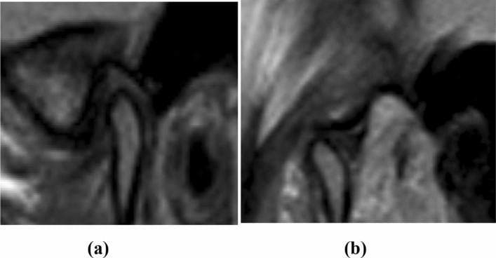 This diagnostic image consists of two sagittal proton density MRI views of the human left temporomandibular joint (TMJ), demonstrating internal derangement. Image (a) depicts the joint in a closed-mouth position, where the low-signal articular disc is visible anteriorly displaced relative to the mandibular condyle. Specifically, the posterior band of the disc is positioned anterior to the 12:30 clock-face reference point relative to the superior aspect of the condyle, diagnostic of anterior disc displacement. Image (b) shows the same joint in an open-mouth position during maximal translation. In this view, the disc has recaptured its functional position, with the intermediate zone properly interposed between the condyle and the articular eminence. This dynamic sequence illustrates anterior disc displacement with reduction (ADDWR). The images are intended for educational use in oral and maxillofacial radiology to teach the radiographic criteria for TMJ disc malposition and joint mechanics.