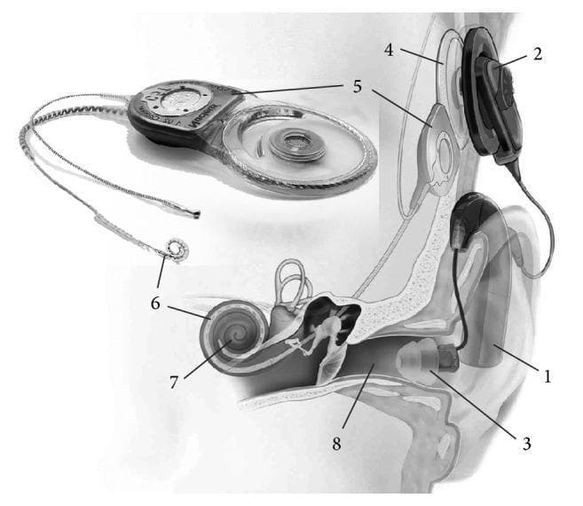 This medical anatomical diagram and clinical illustration depict a hybrid cochlear implant system and its placement within the human ear. The image features a cross-sectional view of the ear anatomy and an inset showing the standalone hardware. External components include a behind-the-ear sound processor (1) connected to an earmould (3) in the external auditory canal (8) for acoustic amplification, and an external transmitter coil (2). Internal components include an implanted receiver/stimulator coil (4) and the main implant body (5) positioned subcutaneously. A flexible electrode array (6) is shown extending into the spiraled cochlea (7) of the inner ear. The diagram illustrates the dual mechanism of hybrid stimulation: electric stimulation of the auditory nerve via the intracochlear electrodes and acoustic amplification of low-frequency sounds through the earmould. Key landmarks include the external auditory meatus, tympanic membrane, ossicular chain, and the snail-shaped cochlea, demonstrating the pathway from sound capture to neural excitation.