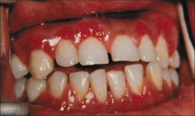 This clinical photograph displays a front-view intraoral examination showing significant gingival enlargement and inflammation. The gingival tissue across the upper and lower anterior regions, as well as the upper posterior buccal areas, exhibits a characteristic fiery red color and a distinctively irregular, granular, and pebbled surface texture. The enlargement is papillary and diffuse, significantly covering the cervical portions of the teeth. Clinical features such as the 'strawberry' or granular appearance are hallmark signs often associated with granulomatous conditions, including tuberculous gingivitis or sarcoidosis. The image serves as an educational example of atypical gingival lesions that present with minimal local deposits (plaque or calculus) but demonstrate severe morphological changes, requiring histopathological correlation to confirm systemic or infectious underlying causes such as tuberculosis.