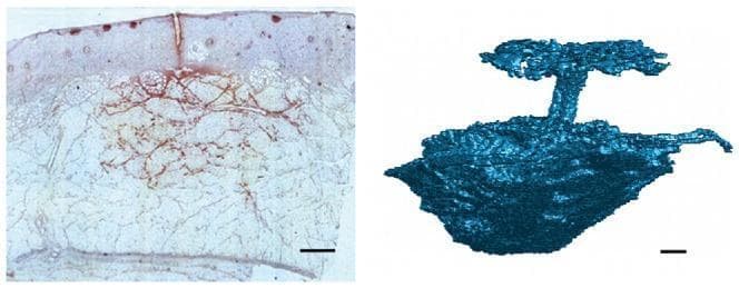 A multi-modal educational visual comparing the subcutaneous distribution of injected insulin. The left panel shows a histological cross-section (light microscopy/immunohistochemistry) of adipose tissue. The dermis is visible as the superior layer, while the injected insulin is stained red, demonstrating its distribution within the fat lobules and the formation of a localized depot. The right panel displays a segmented 3D tomographic reconstruction from an X-ray CT scan of a similar injection. This 3D model illustrates the irregular, somewhat spherical morphology of the injection depot, the vertical injection channel created by the needle, and backflow at the skin surface. The contrast in the CT scan is achieved using an iodine-based agent mixed with the drug. Scale bars of 1 mm are present in both images. This comparison is used to study tissue mechanics, drug delivery patterns, and the localized pressure effects of subcutaneous injections in pharmaceutical research.