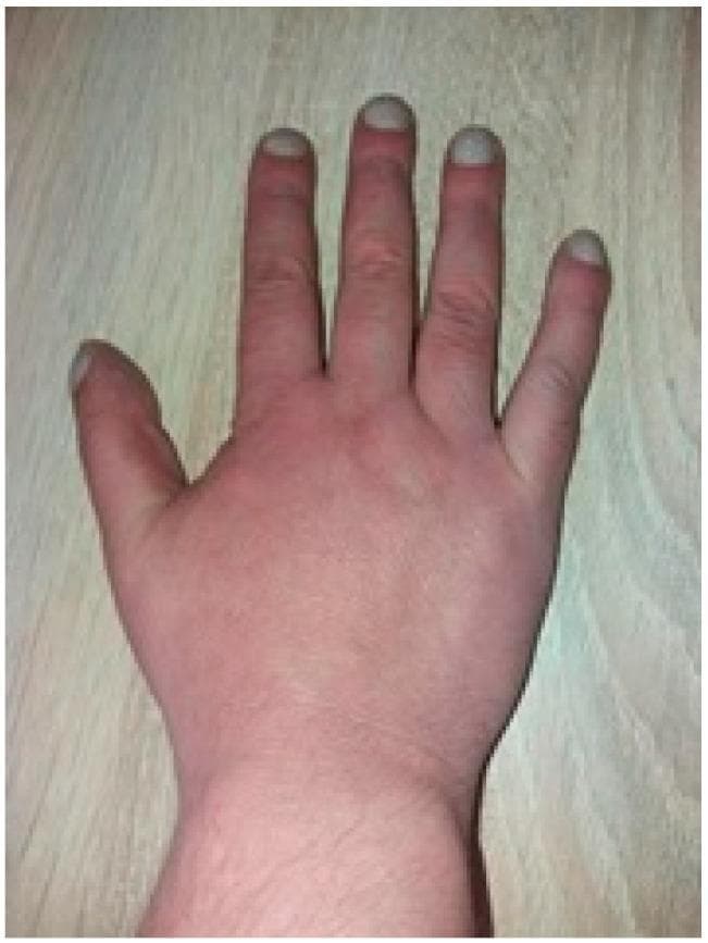 This clinical photograph displays a dorsal view of a human hand demonstrating classic digital clubbing (hippocratic fingers). The distal phalanges of all visible fingers appear bulbous and enlarged, with an increased longitudinal and transverse curvature of the nail plates, giving them a 'watch-glass' or convex appearance. There is a visible loss of the Lovibond angle (the normal 160-degree angle between the nail base and the proximal nail fold). The skin of the hand shows a generalized reddish-to-dusky hue, suggestive of polycythemia or chronic cyanosis. These physical findings are hallmark signs of chronic hypoxemia, frequently associated with underlying conditions such as congenital cyanotic heart disease (e.g., Tetralogy of Fallot) or chronic pulmonary disease. The image serves as an educational tool for identifying secondary physical manifestations of cardiovascular and respiratory pathology.