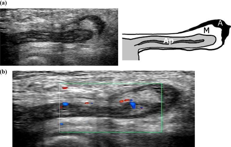 This composite diagnostic image features ultrasonography findings of a de Garengeot hernia, where the vermiform appendix is incarcerated within a femoral hernia sac. Panel (a) presents a B-mode ultrasound and a corresponding schematic diagram. It shows a longitudinal view of a blind-ended, isoechoic tubular structure (labeled 'Ap' for appendix) approximately 5 mm in diameter, which is continuous with the cecum. Surrounding the appendix is a reticular hyperechoic area representing the mesoappendix ('M'), and a localized anechoic fluid collection indicating ascites ('A') medial to the femoral vein. Panel (b) displays a Color Doppler ultrasound of the same anatomical region. Within the green sampling box, distinct red and blue pulsatile blood flow signals are visible along the appendiceal wall. These findings demonstrate preserved vascularity and the absence of significant inflammatory changes such as wall thickening or hyperemia, supporting a clinical diagnosis of an incarcerated but non-inflamed appendix within a femoral hernia.