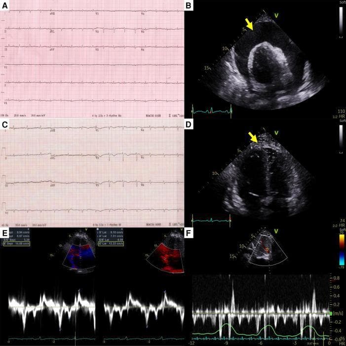 This composite figure illustrates the clinical and diagnostic progression of a patient with effusive-constrictive pericarditis. Panels A and C show 12-lead electrocardiography (ECG). Panel A displays low-voltage QRS complexes, typical of a large pericardial effusion. Panel C, post-pericardiocentesis, shows increased QRS voltage and newly developed T-wave inversions in the anterior leads. Panels B and D provide transthoracic echocardiography (TTE) views. Image B reveals a massive, circumferential anechoic space representing a large pericardial effusion (arrow) causing cardiac tamponade. Image D, following pericardiocentesis, demonstrates significant reduction in effusion but reveals diffuse hyperechoic pericardial thickening and adhesions (arrow). Panels E and F showcase hemodynamic assessment of constrictive physiology. Panel E shows tissue Doppler imaging indicating 'annulus reversus,' where medial early diastolic tissue velocity (e') exceeds lateral velocity. Panel F displays pulse-wave Doppler of hepatic vein flow, highlighting prominent expiratory diastolic flow reversal. Together, these findings characterize the transition from cardiac tamponade to constrictive pericarditis post-drainage.