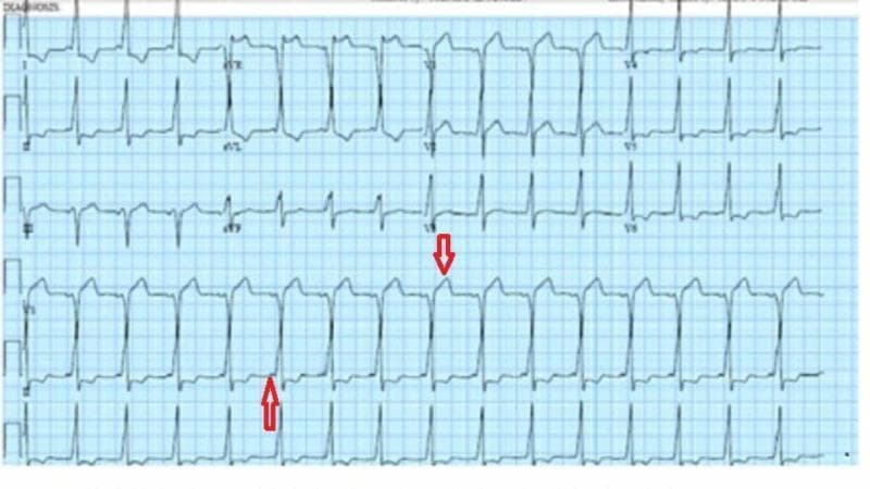 A 12-lead diagnostic electrocardiogram (ECG) demonstrating classic features of ventricular pre-excitation, characteristic of Wolff-Parkinson-White (WPW) syndrome. The tracing shows a notably shortened PR interval (less than 120 ms) followed by widened QRS complexes. A prominent finding is the presence of delta waves, which appear as slurred upstrokes at the beginning of the QRS complexes, most visible in the precordial leads. Red arrows highlight the specific morphology of the slurred QRS complexes and the associated ST-segment changes. Secondary repolarization abnormalities are present, manifesting as ST-segment and T-wave changes discordant with the QRS polarity. This ECG serves as a critical educational example of an accessory pathway (Bundle of Kent) bypassing the atrioventricular node, leading to early ventricular depolarization. The image is categorized under cardiovascular medicine and electrophysiology, suitable for medical students and residents studying cardiac arrhythmias and syncope evaluation.