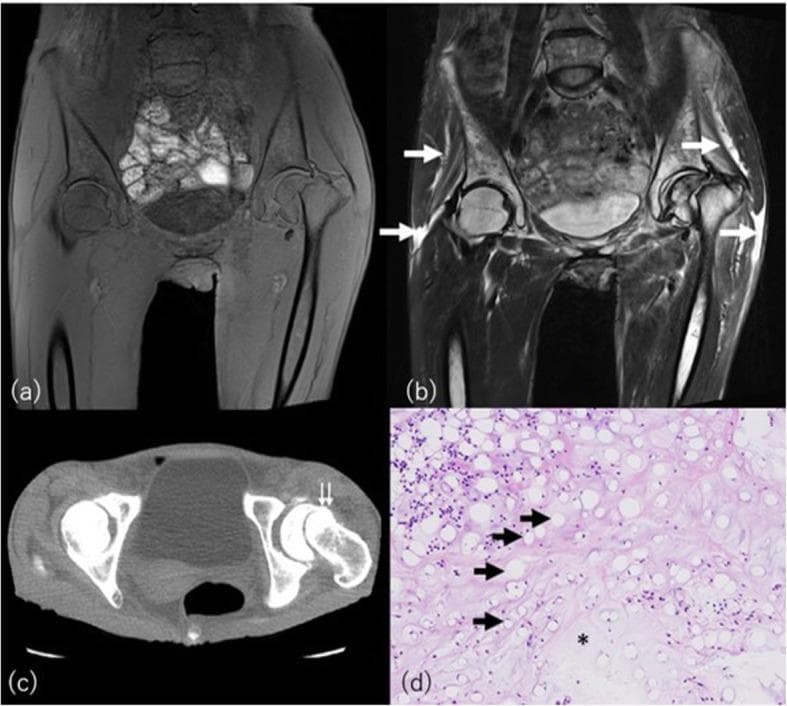 This multi-modal educational figure illustrates serous atrophy of bone marrow (gelatinous bone marrow transformation) and associated findings in a patient with bulimia nervosa. (a) Coronal T1-weighted MRI shows diffuse, abnormal hypointense marrow signal throughout the pelvis and proximal femora, along with a left femoral neck fracture. (b) Coronal STIR MRI reveals a corresponding hyperintense signal within the marrow space and highlights focal edema or serous fluid in the surrounding subcutaneous and intermuscular tissues (white arrows). (c) Axial CT image at the level of the femoral neck confirms the fracture (double arrow) and demonstrates increased attenuation (increased density) of the depleted subcutaneous fat. (d) Histopathological H&E stain (100x magnification) provides the cellular correlation, showing a marked reduction and shrinkage of adipocytes (black arrows), a decrease in hematopoietic cells, and the diagnostic deposition of abundant, amorphous, eosinophilic extracellular gelatinous substances (asterisk). The visual findings emphasize the characteristic imaging appearance of nutritional marrow depletion and the increased risk of insufficiency fractures in eating disorders.