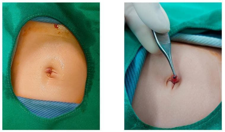 This clinical photograph consists of two panels illustrating postoperative omphalitis (umbilical infection) in a pediatric patient following a surgical procedure. The first panel shows an infant's abdomen prepped for examination, highlighting an erythematous and slightly edematous umbilicus. The second panel depicts a close-up of the umbilical region where a clinician, using metallic surgical forceps, is manipulating the inflamed tissue to reveal a suture reaction. The umbilical site shows localized intense redness and a small incision, consistent with a stitch-induced inflammatory response or granuloma. The images serve as an educational example of minor surgical complications following single-incision laparoscopic surgery, emphasizing the clinical appearance of omphalitis and foreign body reactions to non-absorbable multifilamentous sutures in neonatal or infant patients.