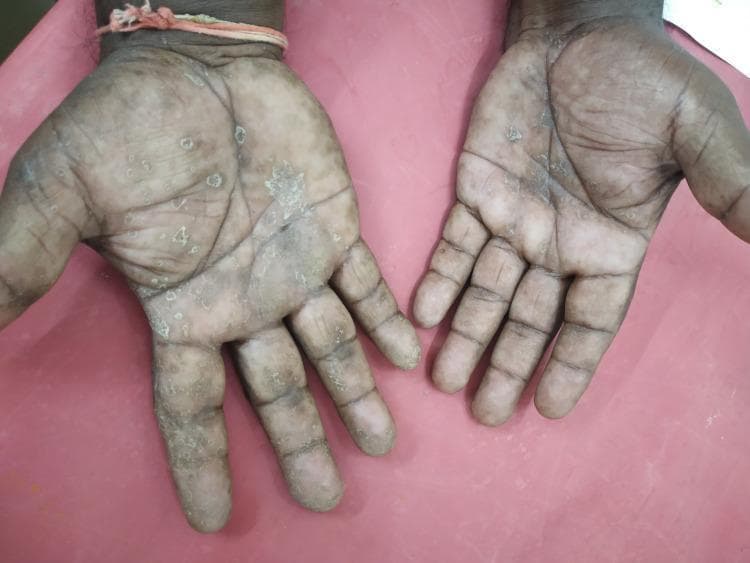 Clinical photograph showing a dermatological manifestation on the palmar and distal dorsal surfaces of bilateral hands, diagnosed as tinea manuum. The image reveals diffuse palmar involvement characterized by xerosis, hyperkeratosis, and fine scaling, particularly concentrated along the palmar creases and across the fingers. Multiple discrete, nummular, well-demarcated scaly plaques are scattered across the palms. There is evidence of mottled dyschromia, with intermixed areas of hyperpigmentation and hypopigmentation. The skin texture appears rough and thickened, with some loss of the normal dermatoglyphic pattern and accentuation of skin lines. The lesions extend from the central palmar region to the volar and lateral aspects of the digits, demonstrating a pattern consistent with chronic fungal infection or hyperkeratotic palmar dermatosis. This visual is relevant for medical education in dermatology, specifically for differentiating between tinea manuum, palmar psoriasis, and chronic hand eczema.