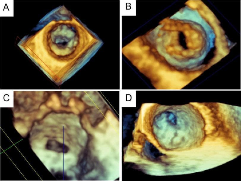 This set of four images (A-D) demonstrates Three-Dimensional Transesophageal Echocardiography (3D TEE) findings in patients with rheumatic mitral stenosis. Image A provides a surgeon's view from the left atrium, showing a restricted mitral valve orifice with diffuse leaflet thickening. Image B shows an en face view from the left ventricular perspective, highlighting the narrowed valve aperture and irregular leaflet surfaces indicative of fibrosis. Image C illustrates rheumatic mitral stenosis characterized by symmetric commissural thickening, resulting in a small, centrally located, circular opening. Image D showcases severe rheumatic involvement with significant asymmetric thickening of the anterolateral commissure, causing a highly eccentric and severely stenotic valve orifice. Collectively, these images illustrate the morphological hallmarks of rheumatic heart disease, including commissural fusion, leaflet thickening, and the resulting reduction in mitral valve area, which are critical for diagnostic grading and planning interventions like percutaneous mitral valvuloplasty.