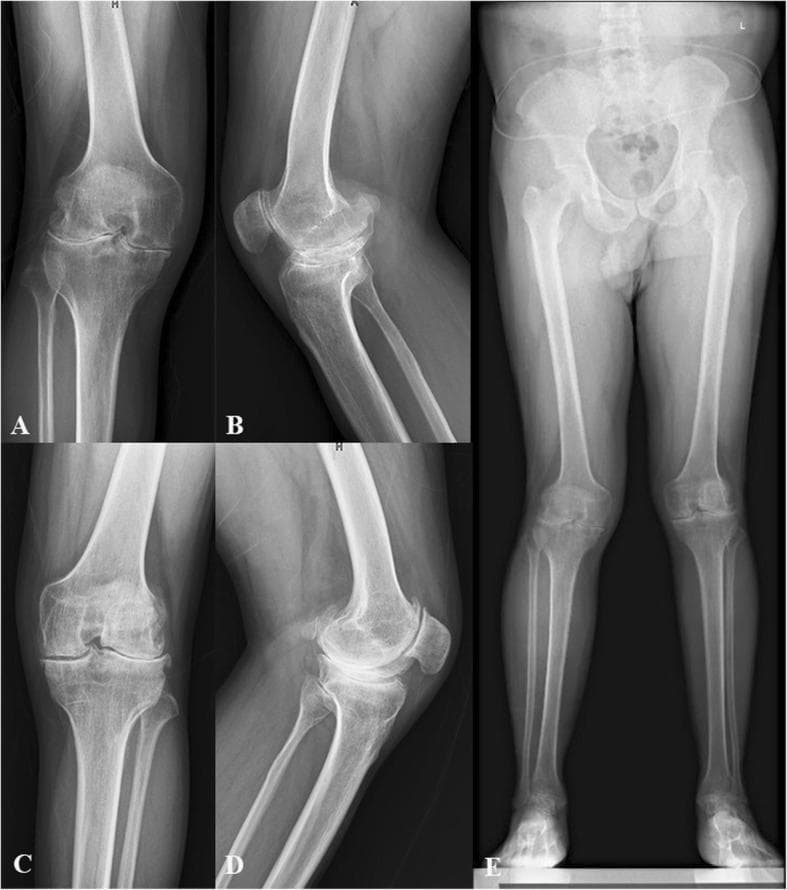 This composite of five diagnostic X-ray radiographs demonstrates severe, bilateral haemophilic arthropathy in a patient scheduled for total knee arthroplasty (TKA). Panels A and C show anteroposterior (AP) views of the right and left knees, respectively, revealing advanced tricompartmental degeneration characterized by severe, asymmetric joint space narrowing, subchondral sclerosis, and significant marginal osteophyte formation. Irregularity of the articular surfaces and squaring of the femoral condyles, typical of chronic hemarthrosis-related damage, are present. Panels B and D provide lateral views, highlighting anterior osteophytes, patellofemoral joint space loss, and posterior subluxation tendencies. Panel E is a full-length, weight-bearing standing AP radiograph of the lower limbs and pelvis, which visualizes the global alignment and mechanical axes. It confirms the symmetric severity of the knee pathology and allows for the assessment of lower limb deformities, such as valgus or varus malalignment, occurring secondary to the extensive articular cartilage and bone destruction. This imaging series illustrates the end-stage clinical manifestations of haemophilic joint disease.