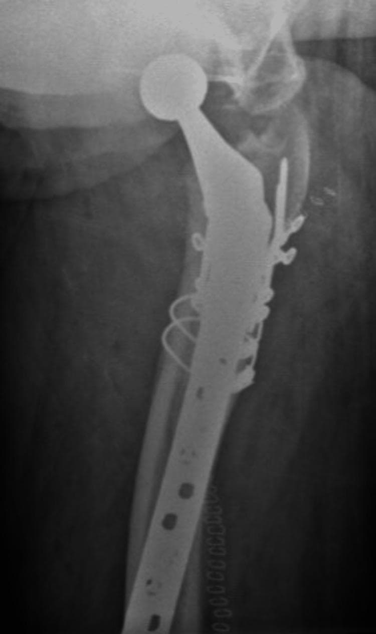 This axial X-ray of the right hip demonstrates a postoperative view of a periprosthetic femoral fracture managed with internal fixation. A primary total hip arthroplasty (THA) is visible, featuring a femoral stem and a prosthetic femoral head articulating within the acetabulum. The fracture site, primarily involving the proximal femur/greater trochanter region, is stabilized with a long lateral locking plate and screw construct extending distally along the femoral shaft. Multiple cerclage wires encircle the proximal femur to provide additional circumferential compression and stability for the fracture fragments around the pre-existing prosthesis. The imaging shows successful anatomical alignment of the bone and hardware placement, which is characteristic of the management of Vancouver B1 or C type periprosthetic fractures where the primary stem remains stable. This clinical image is educational for understanding orthopedic revision strategies and the integration of osteosynthesis hardware with existing arthroplasty components.