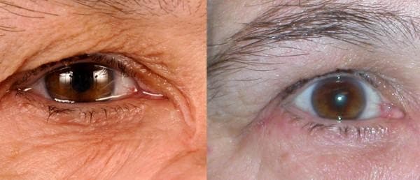 This clinical comparison photograph illustrates the management of severe hyperlacrimation (epiphora) using Botulinum Toxin A (BTA). The left frame shows the patient's eye with significant pathological tearing; visible features include a high tear meniscus, pooling of tears in the lower eyelid, and macerated, moist periorbital skin with pronounced wrinkling and mild erythema. This condition resulted from a lacrimal duct obstruction following maxillary sinus tumor resection. The right frame demonstrates the therapeutic effect after BTA injection into the palpebral part of the lacrimal gland. In this image, the tear volume is visibly normalized, the tear film is stable without overflow, and the surrounding skin appears drier and healthier. The comparison highlights BTA injection as a viable interim or alternative treatment for hyperlacrimation caused by ductal stenosis or 'crocodile tears' syndrome, effectively reducing lacrimal secretion without inducing xerophthalmia (dry eye).