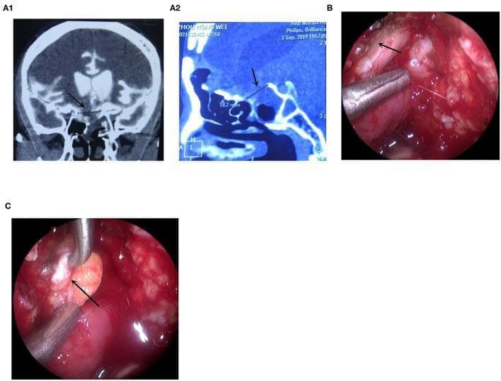 This composite educational graphic illustrates the diagnosis and endoscopic repair of a cerebrospinal fluid (CSF) leak. Panels A1 and A2 show Computed Tomography Cisternography (CTC) images in coronal and sagittal planes, respectively. Black arrows identify a skull base defect located at the right tuberculum sellae, adjacent to the sella turcica and sphenoid sinus. Panels B and C are intraoperative endoscopic photographs demonstrating a transnasal surgical approach. Image B captures the surgical site after saline injection to identify the precise site of the CSF leak (indicated by an arrow). Image C shows the 'bath-plug' repair technique, where a metallic surgical instrument is used to plug the defect with fascia lata (reddish-pink tissue, indicated by an arrow). This series demonstrates the clinical workflow from radiological localization to surgical intervention for managing refractory skull base fractures and associated rhinorrhea.