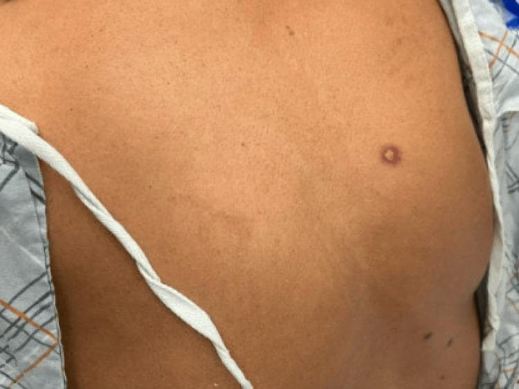 Clinical photograph of a patient's mid-back displaying a classic targetoid (iris) lesion. The primary lesion is well-circumscribed and located on the mid-right posterior trunk. It features three distinct zones: a central dusky, possibly eroded or blistered core; an intermediate pale edematous ring; and a peripheral erythematous rim. This 'target-like' morphology is a hallmark of erythema multiforme. The surrounding skin is of medium tone with visible hair follicles and minor scattered nevi but is otherwise free of widespread exanthema in this view. The clinical context suggests an immunologic reaction, possibly associated with medication-related hypersensitivity or Stevens-Johnson Syndrome (SJS) spectrum given the reported mucosal involvement. This image serves as an educational reference for identifying characteristic skin signs in inflammatory and hypersensitivity dermatoses.