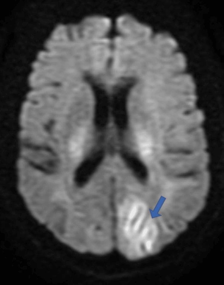 This diagnostic image is an axial section of a Diffusion-Weighted Imaging (DWI) MRI of the brain, a primary modality for detecting acute ischemic changes and cytotoxic edema. The image reveals multiple areas of hyperintensity representing diffusion restriction. A prominent area of high signal intensity is indicated by a blue arrow in the left posterior region, specifically involving the cortical gyri of the parieto-occipital lobe. This 'gyriform' or ribbon-like pattern follows the anatomical contours of the cerebral cortex, suggesting cortical involvement. The findings are clinically significant for pathologies such as Posterior Reversible Encephalopathy Syndrome (PRES) or acute ischemic stroke. The educational focus is on identifying patterns of diffusion restriction and their anatomical distribution in the context of neurological symptoms like cortical blindness. This material is suitable for intermediate to advanced medical students and radiology residents studying neuroradiology and vascular neurology.