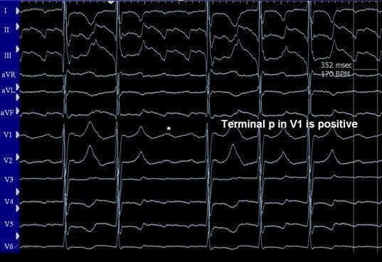 This diagnostic image is a 12-lead electrocardiogram (ECG) demonstrating a macro-reentrant atrial tachycardia, specifically atrial flutter. The rhythm is characterized by a rapid, regular atrial rate of approximately 170 BPM (352 msec cycle length as annotated). A classic 'sawtooth' pattern of flutter waves is most prominent in inferior leads II, III, and aVF, showing predominantly negative or biphasic polarity. Lead V1 displays a distinctive morphology where the terminal portion of the flutter wave is positive (noted with an asterisk and text label), a key diagnostic feature for localized macro-reentry. The ventricular response is regular and slower than the atrial rate, indicating a fixed atrioventricular (AV) conduction ratio. In the clinical context of a post-Fontan procedure patient, these visual findings suggest the flutter circuit is cavo-tricuspid isthmus (CTI) dependent. This ECG serves as an educational tool for identifying atypical atrial flutter morphologies in patients with complex congenital heart disease and prior surgical baffles or patches.