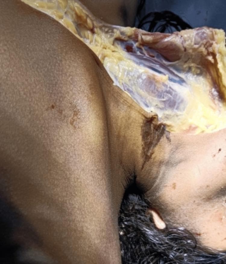This forensic clinical photograph depicts an autopsy examination of a human neck, illustrating findings consistent with suspension hanging. A prominent, dark brown, parchment-like ligature mark is visible on the right lateral aspect of the neck. The mark exhibits an oblique, upward orientation toward the mastoid region, characteristic of antemortem compression. A surgical dissection flap has been reflected to expose the underlying subcutaneous tissue and superficial fascia. This underlying tissue appears white, glistening, and yellowish, without evidence of significant subcutaneous or intramuscular hemorrhage, which is a key diagnostic feature in certain forensic assessments of ligature-related injuries. The image serves as an educational resource for forensic pathology, specifically demonstrating the external morphology of a ligature furrow and the corresponding internal examination of neck structures during a medicolegal postmortem.