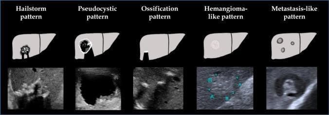 This educational comparison chart illustrates the Echinococcus multilocularis Ulm classification—ultrasound (EMUC-US) for hepatic alveolar echinococcosis (AE). The diagram presents five distinct ultrasonographic patterns using side-by-side schematic liver illustrations and corresponding B-mode clinical ultrasound frames. 1) Hailstorm pattern: Characterized by a heterogeneous cluster of bright echoes with significant posterior acoustic shadowing. 2) Pseudocystic pattern: Depicts a large, well-defined anechoic (liquid-filled) area with irregular borders. 3) Ossification pattern: Shows focal, highly echogenic calcifications with sharp, dense posterior shadowing. 4) Hemangioma-like pattern: Displays a circumscribed, homogeneously hyperechoic lesion with a smooth texture, mimicking a benign hemangioma. 5) Metastasis-like pattern: Presents multiple, discrete, hypoechoic nodules with a target-like or 'bulls-eye' appearance. This tool is used in radiology and hepatology for the differential diagnosis of parasitic liver lesions and to categorize disease morphology according to established clinical criteria.