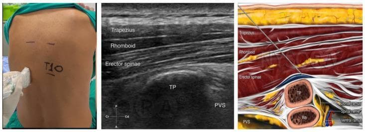 This composite educational graphic illustrates the procedure for a ultrasound-guided erector spinae plane block (ESPB). The left panel is a clinical photograph showing the sagittal positioning of a linear ultrasound transducer on a patient's back, approximately 3 cm lateral to the T10 spinous process. The middle panel is a sagittal diagnostic ultrasound image labeling the relevant sonographic anatomy: the trapezius, rhomboid, and erector spinae muscles as hyperechoic layers, with the hyperechoic shadow of the transverse process (TP) and the adjacent paravertebral space (PVS) visible. The right panel is an anatomical cross-section diagram demonstrating the in-plane needle technique. It shows the needle traversing the trapezius, rhomboid, and erector spinae muscles in a cephalad-to-caudad orientation. The needle tip is correctly positioned in the fascial plane deep to the erector spinae muscle and superficial to the transverse process, where local anesthetic is administered to target the dorsal and ventral rami of the spinal nerves. This material is designed for teaching regional anesthesia techniques and paraspinal anatomy.