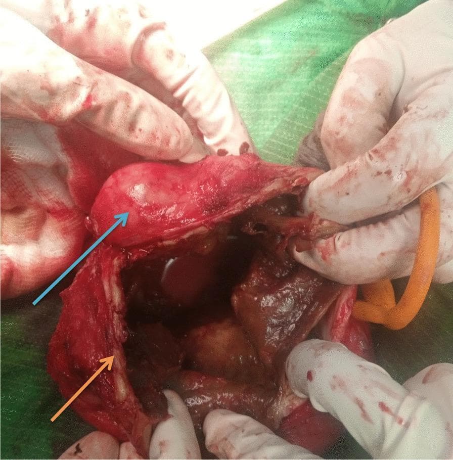 An intraoperative clinical photograph showing a surgical dissection of the scrotum. A blue arrow identifies the left testis, which appears as a smooth, glistening, ovoid structure. An orange arrow points to the thickened and irregular wall of the tunica vaginalis, which demonstrates prominent, whitish, eggshell-like calcific deposits. The surgical field reveals a dark, turbid fluid collection within the scrotal sac, consistent with a chronic hematocele or complex hydrocele. Gloved hands are visible retracting the tissues to expose the internal pathology. The image illustrates a rare complication of long-standing scrotal fluid collections where the parietal layer of the tunica vaginalis undergoes extensive dystrophic calcification, requiring surgical excision (hydrocelectomy). This content is relevant for urological surgery education, specifically regarding the diagnosis and management of chronic scrotal masses and the visual identification of calcified anatomical structures.