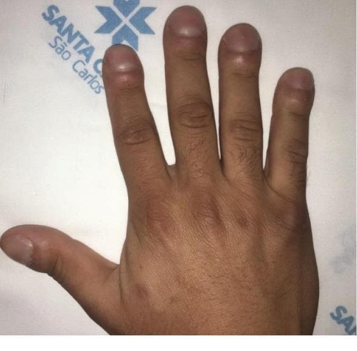A clinical photograph of a human hand demonstrating classic digital clubbing (Hippocratic fingers). The image shows the dorsal view of the fingers, where there is significant bulbous enlargement and rounding of the distal phalanges. Key visual features include an increased longitudinal and transverse curvature of the nails, resulting in a 'watch-glass' appearance. The Lovibond angle (the angle between the nail plate and the proximal nail fold) is visibly obliterated and exceeds 180 degrees, a hallmark sign of the condition. The soft tissue at the nail base appears thickened and spongy. This finding is clinically significant as an indicator of chronic hypoxemia often associated with primary ciliary dyskinesia (PCD), bronchiectasis, or cyanotic cardiovascular diseases. The photograph is an educational example used in internal medicine and pulmonology to demonstrate physical examination signs of systemic or pulmonary pathology.