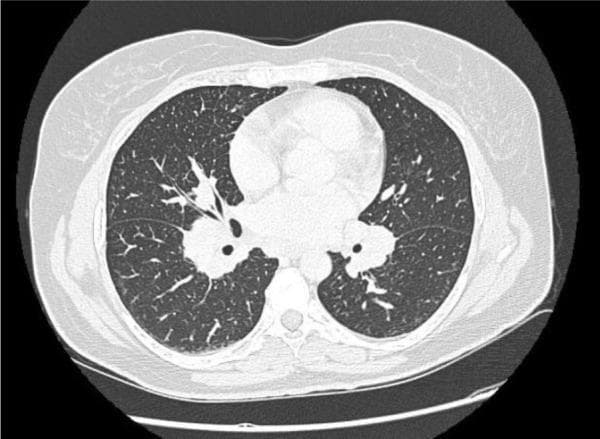 This diagnostic axial CT image of the thorax, presented in a lung window, demonstrates classic radiographic features of pulmonary sarcoidosis. Key findings include prominent, systemic bilateral hilar and mediastinal lymphadenopathy, characterized by enlarged, soft-tissue density nodes at the root of both lungs. The lung parenchyma exhibits a subtle but widespread reticulonodular infiltration pattern, most notably in the mid-to-lower lung zones, consisting of fine linear opacities and small nodular densities scattered throughout the interstitial space. These findings lack significant consolidation or pleural effusion. In the clinical context of Löfgren’s syndrome—an acute presentation of sarcoidosis—this imaging captures the characteristic triad involving lymph node enlargement and pulmonary parenchymal involvement. This case serves as an educational example for radiology and pulmonology students to recognize the distribution of sarcoid-related adenopathy and the characteristic 'ground-glass' like texture of interstitial lung disease.