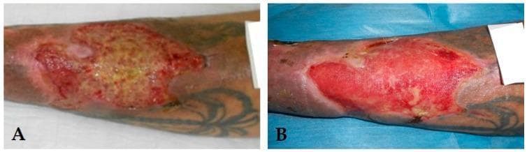 This comparison chart consists of two clinical photographs (A and B) demonstrating the progression of a venous leg ulcer (VLU) through different stages of wound healing. Image A displays a chronic inflammatory ulcer characterized by a significant amount of yellow fibrinous slough and necrotic debris covering the wound bed, surrounded by irregular, erythematous borders indicating localized inflammation. In contrast, image B shows the same anatomical site following therapeutic intervention, now presenting as a granulating ulcer. This stage is marked by a healthy, beefy-red wound bed with visible granulation tissue and a marked reduction in yellow slough. Both images show the ulcer located on the lower leg, with surrounding hyperpigmented skin consistent with chronic venous insufficiency. This visual comparison illustrates the transition from a 'blocked' inflammatory state to an active proliferative phase of wound repair, serving as an educational tool for identifying wound bed characteristics and assessing healing progress in dermatology and wound care specialties.