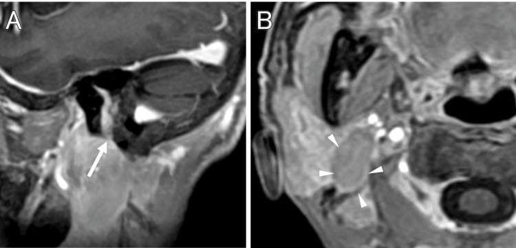 This diagnostic imaging study consists of two contrast-enhanced T1-weighted MRI scans (Panel A: sagittal view; Panel B: axial view) demonstrating a tumor's extracranial extension along the facial nerve pathway. Panel A shows an enhancing, linear-to-irregular lesion passing through the mastoid segment of the facial nerve (marked with a white arrow), extending inferiorly toward the stylomastoid foramen. Panel B illustrates the subsequent infiltration of the right parotid gland. The tumor appears as multiple regions of hyperintense signal (marked with white arrowheads) within the glandular parenchyma, exhibiting an irregular and diffuse enhancement pattern. The visual evidence supports an invasive growth process originating from the internal auditory canal/temporal bone and extending into the cervical soft tissues via the facial nerve canal. This case illustrates the radiological presentation of perineural tumor spread, a critical finding in the differential diagnosis of facial nerve palsy and skull base pathology, such as facial schwannoma or malignant lymphoma.