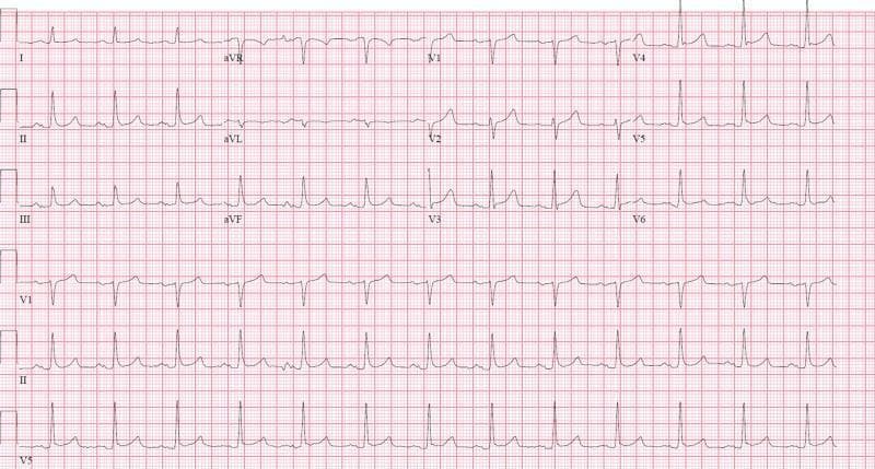 A standard 12-lead electrocardiogram (ECG) displayed on a traditional pink grid background. The tracing demonstrates a normal sinus rhythm characterized by a regular ventricular rate and consistent R-R intervals. Distinct P waves precede every QRS complex, particularly visible as upright deflections in leads II, III, aVF, and V2 through V6. The QRS complexes exhibit normal morphology and duration without evidence of widening or bundle branch blocks. The ST segments are isoelectric throughout all limb and precordial leads, indicating an absence of acute ST-elevation myocardial infarction (STEMI) or significant ST-depression suggestive of ischemia. T waves are generally upright and symmetrical across the precordium. The tracing includes a rhythm strip at the bottom (leads V1, II, and V5) for continuous assessment of the cardiac cycle. This diagnostic image represents a baseline cardiac evaluation for a patient presenting with syncope and hypovolemic shock, providing a clinical comparison for later episodes of potential coronary vasospasm.