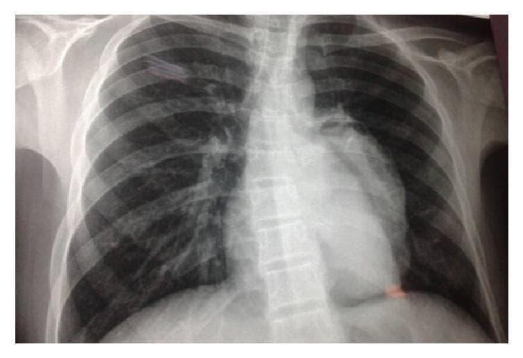 This diagnostic image is a posteroanterior (PA) view chest X-ray illustrating a significant abnormality of the cardiac silhouette. A distinct, rounded prominence is visible along the left cardiac border, suggestive of an enlarged pulmonary trunk or a localized mass. A key radiographic feature is the 'crescent sign'—a thin, radiolucent (dark) rim located at the superior aspect of the prominence, indicating air or low-density interface between the lesion and the adjacent lung or vascular structures. The trachea appears midline, and the right lung field shows no gross consolidations, although the right hilar region appears prominent. This visual is characteristic of pulmonary artery dilation or specific cystic lesions (such as a hydatid cyst) and serves as an educational example of the crescent sign in thoracic radiology for medical students and clinicians specializing in pulmonology and radiology.