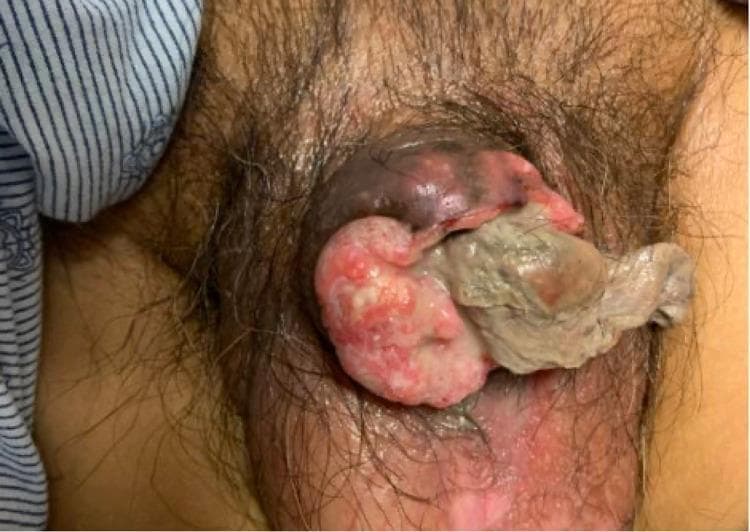 Clinical photograph of the male pelvic region demonstrating an advanced stage of penile squamous cell carcinoma. The image shows a large, exophytic mass that has extensively destroyed and replaced the normal penile architecture, including the glans and distal shaft. The lesion is multi-lobulated and exhibits heterogenous surface features, characterized by erythematous, granular tissue and significant areas of gray-white tissue necrosis (slough). There is visible foul, purulent discharge emanating from the central portion of the mass. The surrounding skin of the pubic area and proximal shaft shows signs of secondary inflammation, erythema, and anatomical distortion. This image serves as a clinical example of a T4 stage penile malignancy, illustrating the aggressive locally invasive nature of the disease and the resulting complete obliteration of normal external genitalia structures.